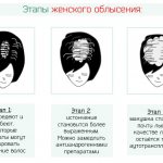 Stages of female scalp baldness