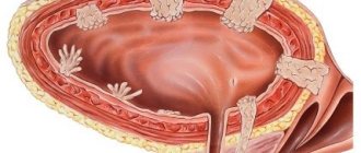 What you need to know about bladder cancer in women