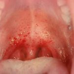 pharyngitis photo of throat
