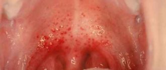 pharyngitis photo of throat