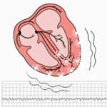 Фибрилляция желудочков на ЭКГ: причины, признаки, прогноз