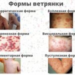 Forms of chickenpox