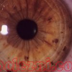 Photo explaining what neurofibromatosis is