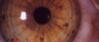 Photo explaining what neurofibromatosis is