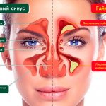 sinusitis