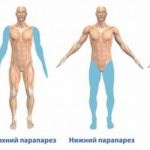 Hemiplegia - symptoms and treatment, photos and videos.