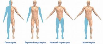 Hemiplegia - symptoms and treatment, photos and videos.