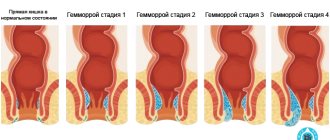 Haemorrhoids