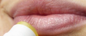 Herpes_lips