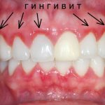 Гингивит