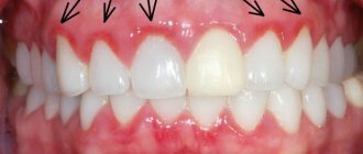 Gingivitis