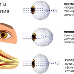 Гиперметропия (дальнозоркость) слабой степени у ребенка, средней, тяжелой. Причины, лечение