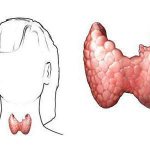 гипертиреоз симптомы у женщин