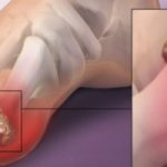 Гиперурикемия — что это такое и как лечить патологию?