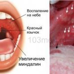 The main signs of herpes sore throat in children and adults