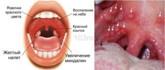 Главные признаки герпесной ангины у детей и взрослых