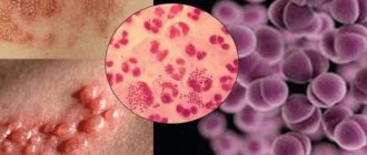 Gonorrhea symptoms in men photo