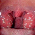 throat with lacunar tonsillitis