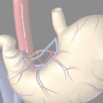 хиатальная грыжа