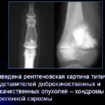 Chondroma and osteogenic sarcoma
