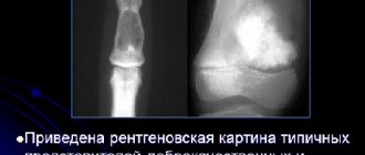 Хондрома и остеогенная саркома