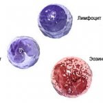 Хронический миелолейкоз