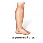 Instructions for use of the drug Lyoton: features of use, reviews and price