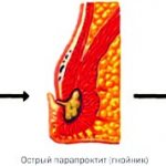 How to treat acute paraproctitis? Symptoms and causes 