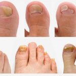 What does nail fungus look like?