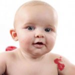 Как вылечить гемангиому в домашних условиях