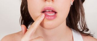 how to cure herpes on the lips in 1 day at home. Aloe juice is used: externally - make compresses, internally - a teaspoon before eating. Bitter juice can be diluted with a small amount of honey.