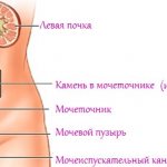 Stones in the ureters