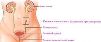 Камни в мочеточниках