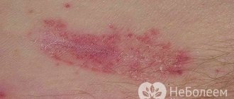 Skin candidiasis often affects people with immunodeficiency.