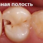 caries photo of a chewing tooth affected by caries, dentistry in Samara