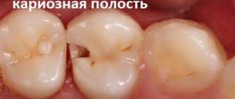 кариес фото пораженного кариесом жевательного зуба стоматология в самаре