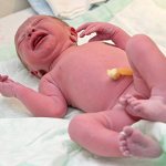 Кефалогематома у новорожденных на голове: причины, как лечить, профилактика