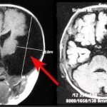 Brain cyst