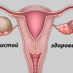 Киста желтого тела правого и левого яичника