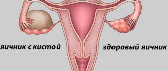 Corpus luteum cyst of the right and left ovary