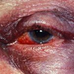 eye contusion treatment