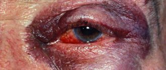 eye contusion treatment