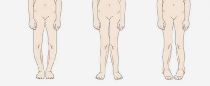 Врожденная косолапость детская хирургия. Врожденная косолапость ...