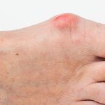 bunion on the foot, how to treat