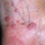 Lichen planus in humans. Photos, stages, signs, treatment. Clinical guidelines 