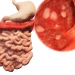 Кровотечение из прямой кишки