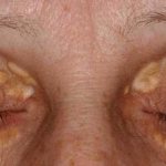 What is facial skin xanthoma?