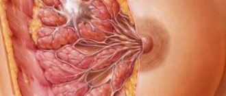 Lactostasis