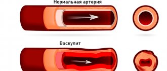лечение васкулита в европе