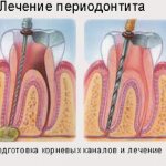 лечение воспаления тканей зубов и десен